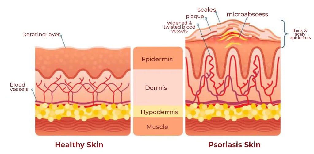 🚨 KOLMAX TRATAMIENTO EFECTIVO CONTRA LA PSORIASIS, DESCAMACIÓN, ENROJECIMIENTO Y DERMATITIS.