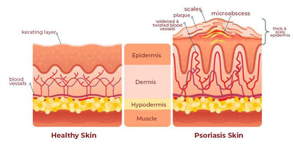 🚨 KOLMAX TRATAMIENTO EFECTIVO CONTRA LA PSORIASIS, DESCAMACIÓN, ENROJECIMIENTO Y DERMATITIS.