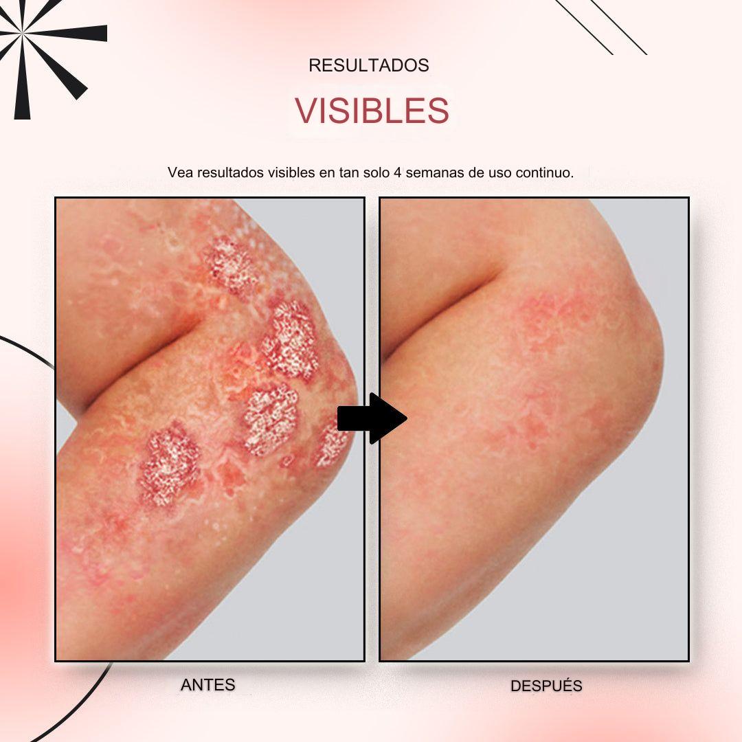 🚨 KOLMAX TRATAMIENTO EFECTIVO CONTRA LA PSORIASIS, DESCAMACIÓN, ENROJECIMIENTO Y DERMATITIS.