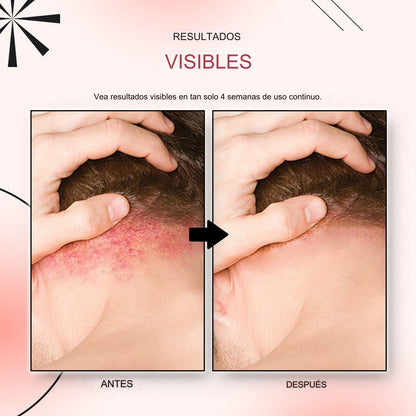 🚨 KOLMAX TRATAMIENTO EFECTIVO CONTRA LA PSORIASIS, DESCAMACIÓN, ENROJECIMIENTO Y DERMATITIS.