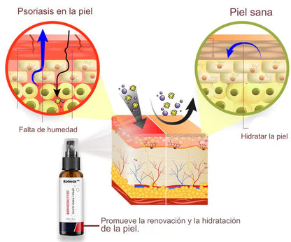 🚨 KOLMAX TRATAMIENTO EFECTIVO CONTRA LA PSORIASIS, DESCAMACIÓN, ENROJECIMIENTO Y DERMATITIS.