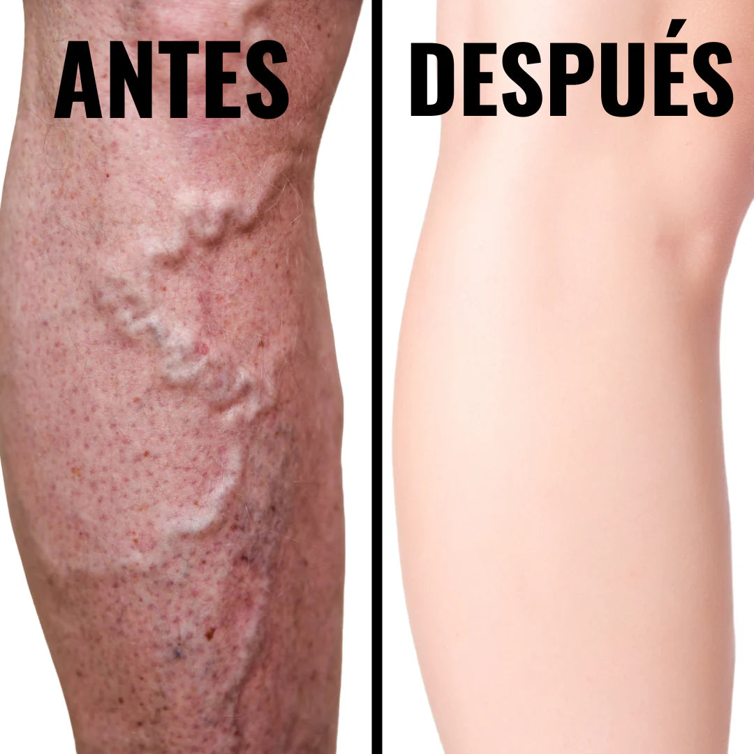 🚨Medias de compresion VitalPress COMBATE VARICE, TROMBOS, HINCHAZÓN Y DOLOR