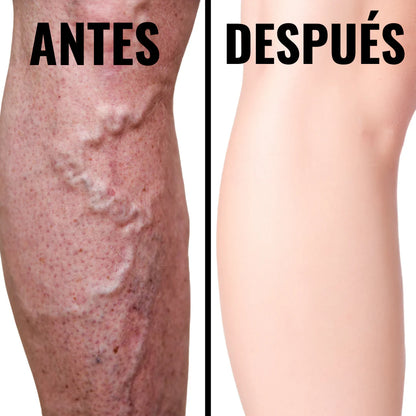 🚨Medias de compresion VitalPress COMBATE VARICE, TROMBOS, HINCHAZÓN Y DOLOR